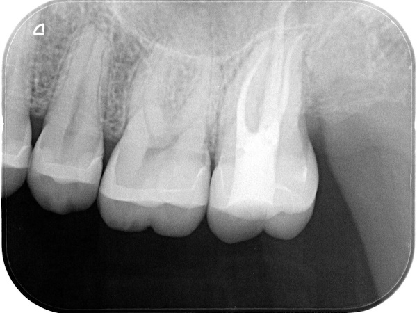 After image