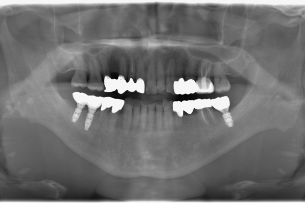 After image