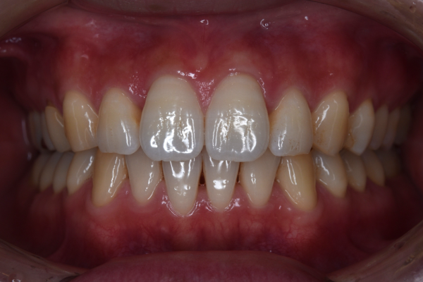 After image