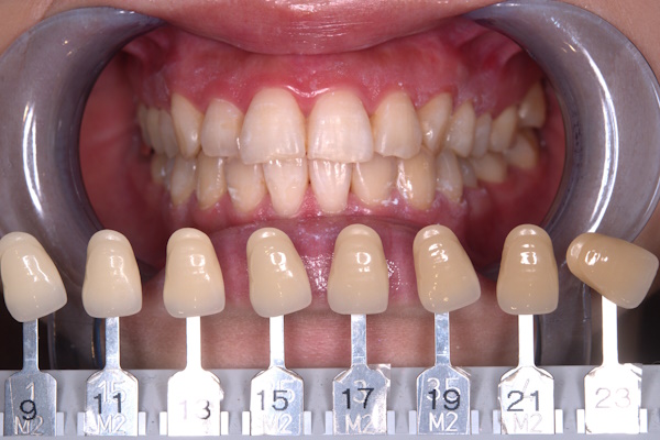 After image