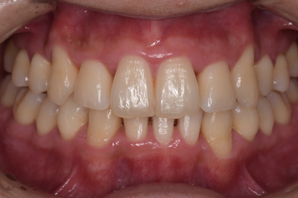 After image