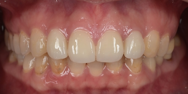 After image