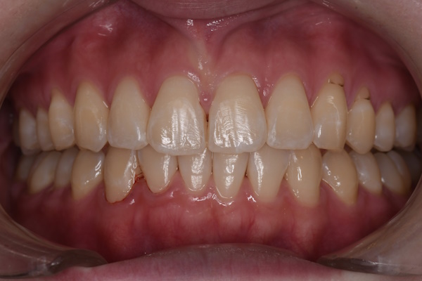After image