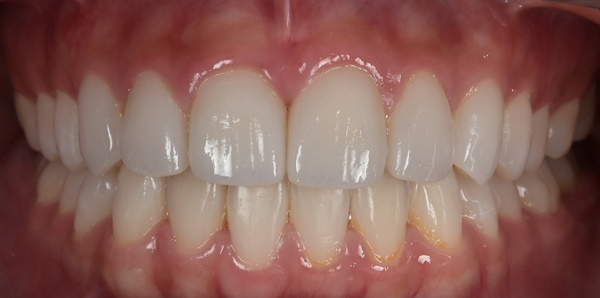 After image