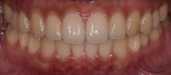 After image