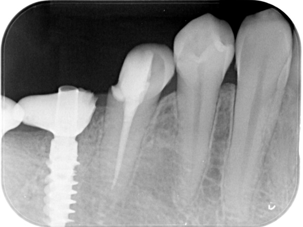After image