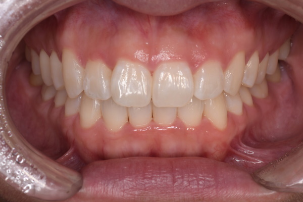 After image