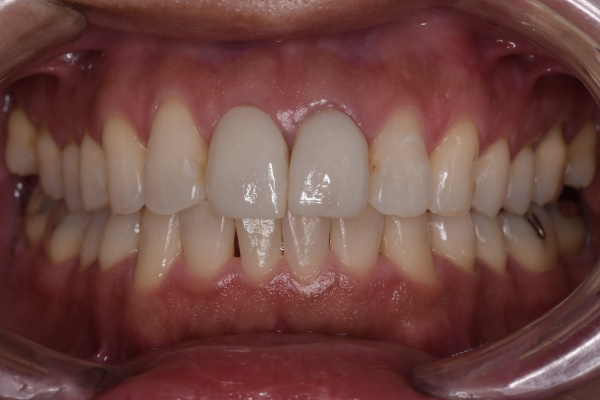 After image