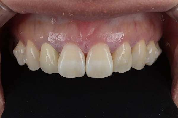 After image