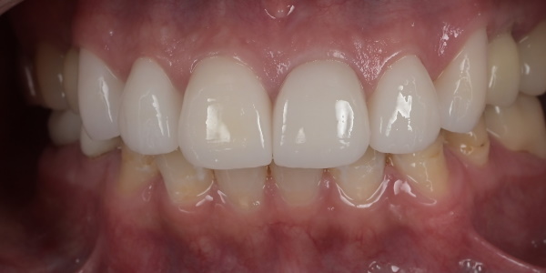 After image